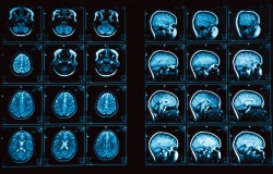 снимок МРТ головного мозга человека
