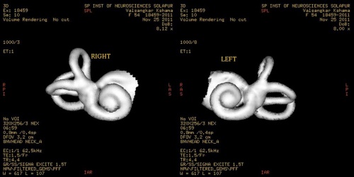 3D снимок слухового нерва