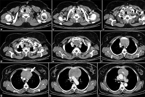 снимок МРТ органов расположенных в грудной клетке