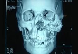 3d изображение челюсти и черепа