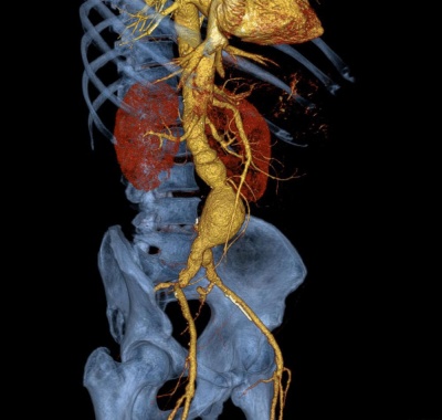 3D снимок аорты брюшной полости