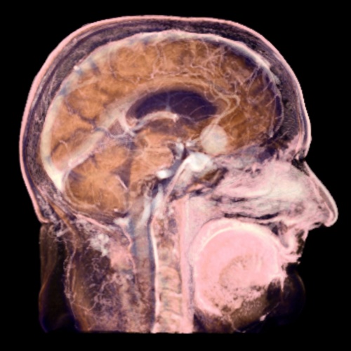 вид головного мозга на томографе