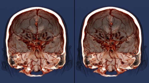 результат МРТ  мозга головы