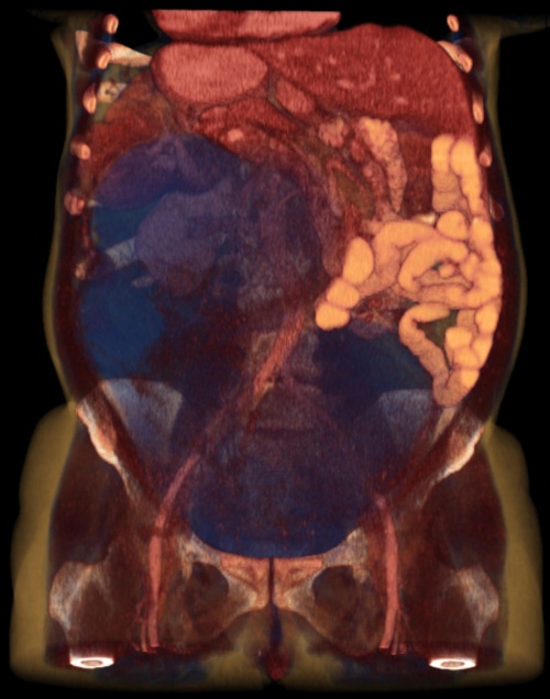 томография органов пищеварения