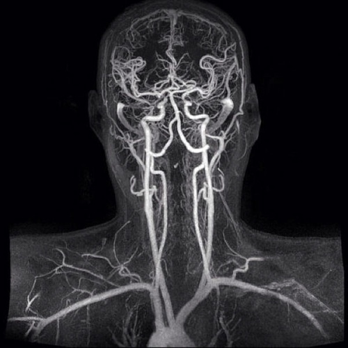 сосудистая система мозга головы на снимке тамографа
