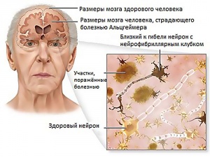 области поражения мозга