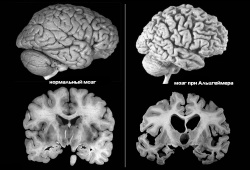 вид мозга до и после болезни
