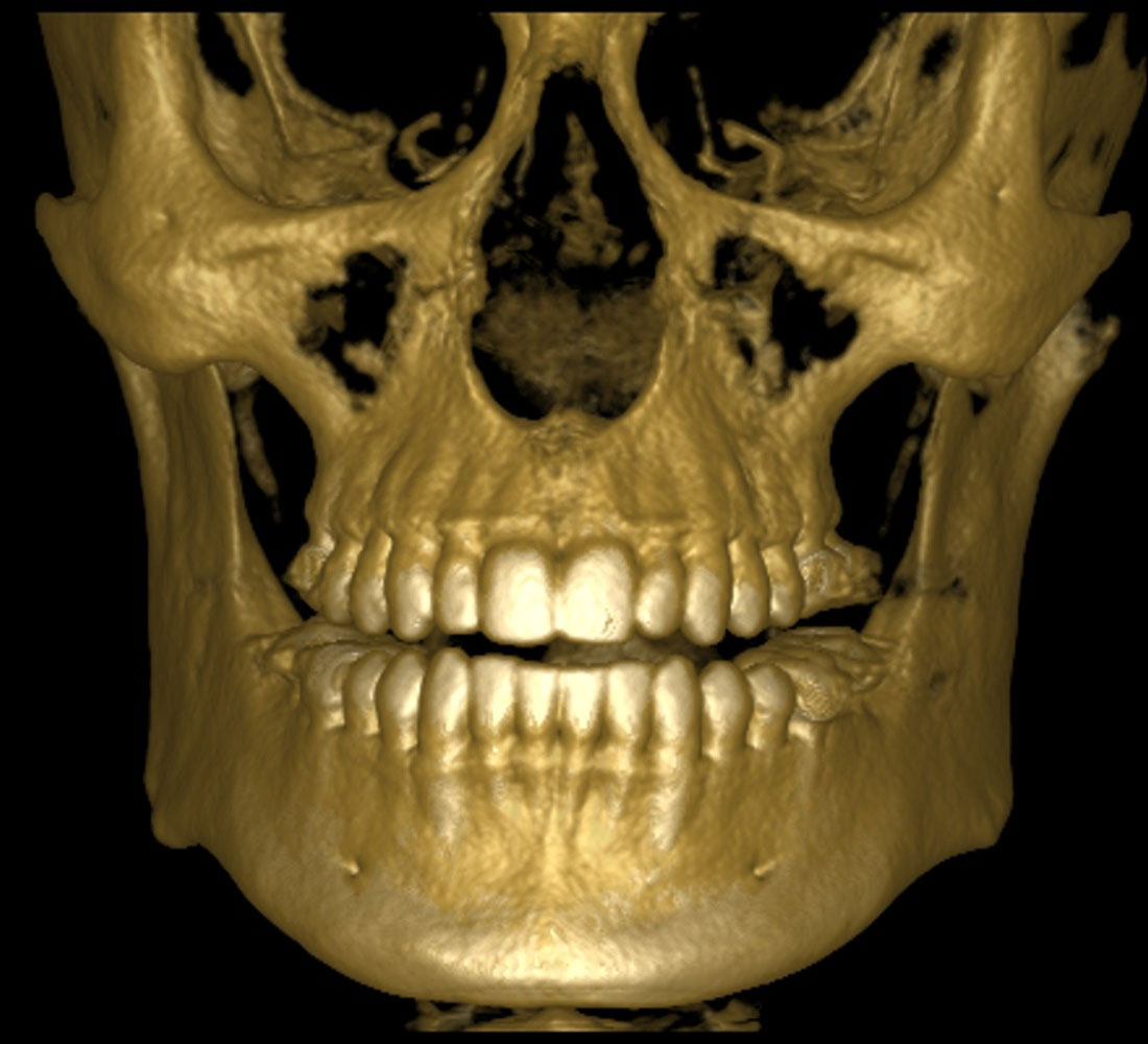 Компьютерная томография зубов и челюсти – снимок 3d