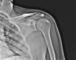 снимок МРТ плечевого сустава