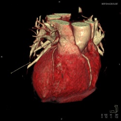 снимок сердца на тамографе