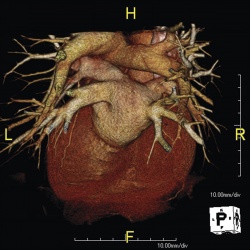 МРТ снимок сердца
