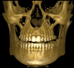 снимок зубов на 3D тамографе