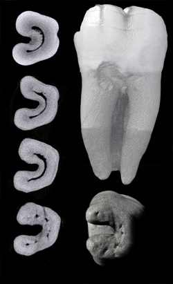 3Д снимок зуба