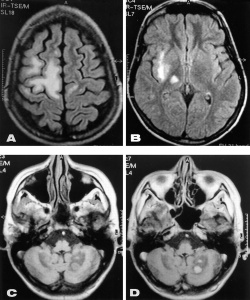 снимок МРТ мозга головы