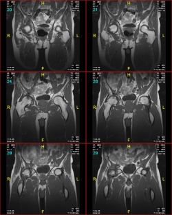 снимок МРТ тазобедренных суставов