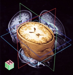 3D снимок головного мозга сделанный на томографе