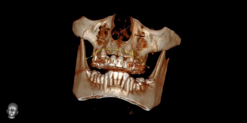 снимок зубов 3D