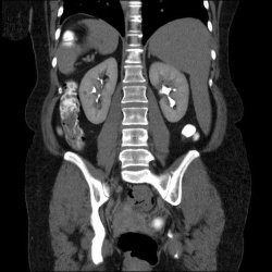 снимок органов брюшной полости на томографии