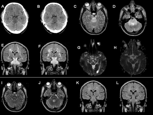 снимок человеческого мозга на томографе