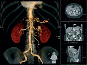 трехмерный снимок почек на томографе
