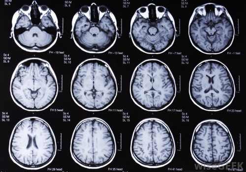 снимок головного мозга с контрастным веществом