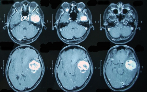 опухоль в головном мозге на снимке МРТ