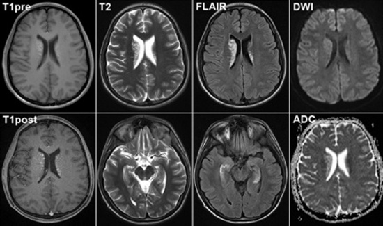 послойный снимок головного мозга выполненный на МРТ