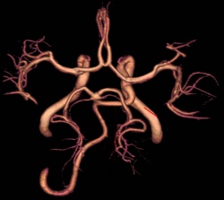 3d снимок артерий мозга