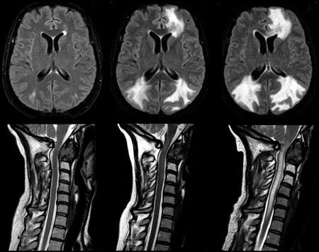 МРТ снимок мозга и шейного отдела