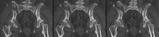 снимок костей малого таза на томографе
