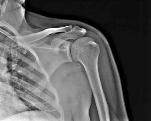 КТ снимок плечевого сустава на томографе