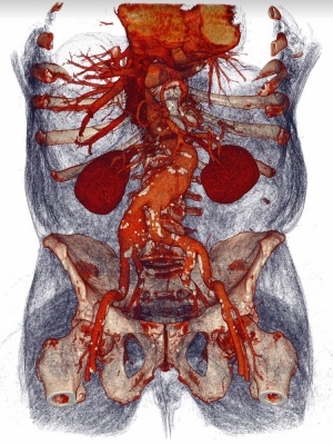 магнитно-резонансная томография брюшного отдела аорты