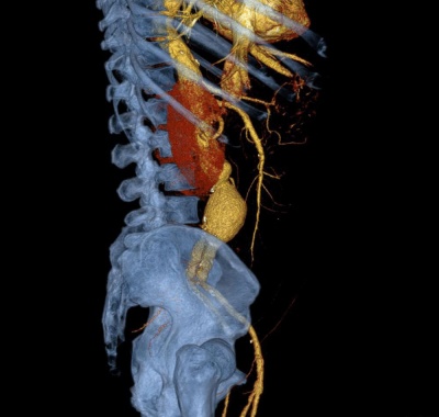 аорта отдела брюшного пространства на томографе