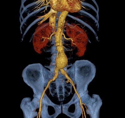 МРТ снимок брюшной аорты