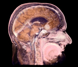 томография мозга с контрастированием