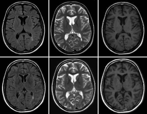 снимок томографии головного мозга