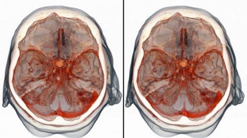 диагностика мозга при инсульте