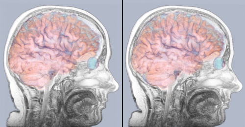 томография головного мозга при инсульте