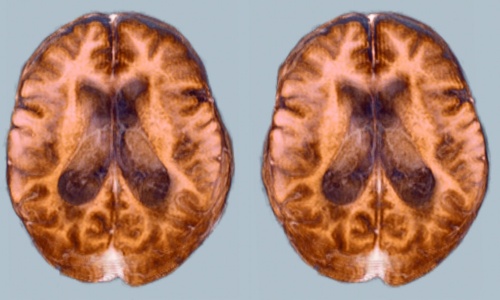 томография опухоли головного мозга