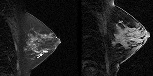 томография при раке молочной железы