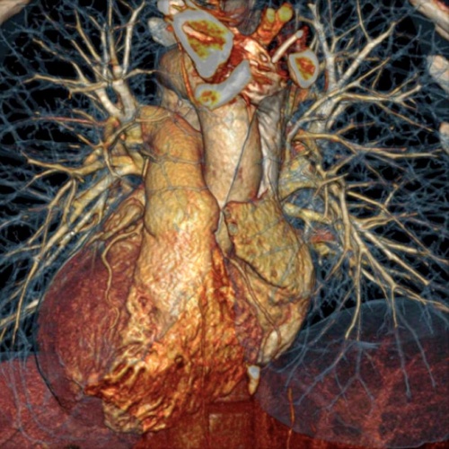 снимок сердца на томографе