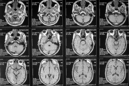 снимок мозга при диагностике инсульта