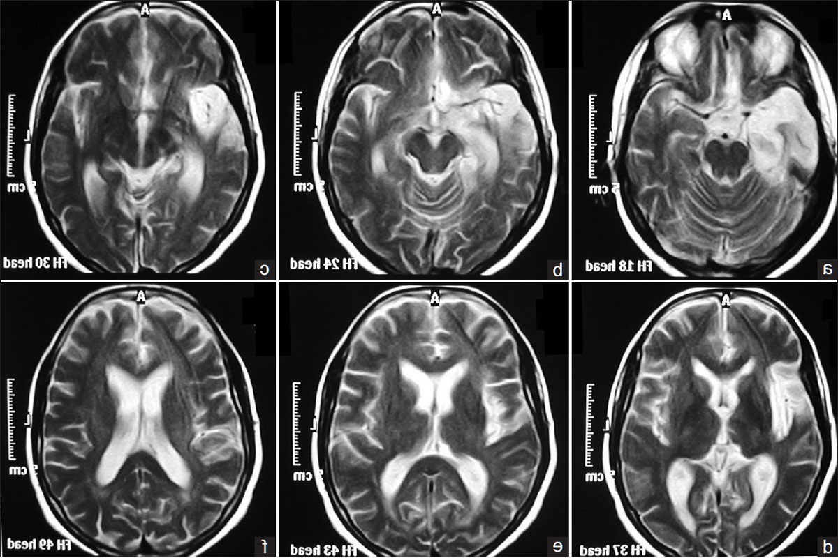Дисциркуляторные изменения головного мозга что это такое. Энцефалопатия на кт мозга. Дисциркуляторная энцефалопатия на кт. Дисциркуляторная энцефалопатия мрт. Магнитно резонансная томография головного мозга энцефалопатия.