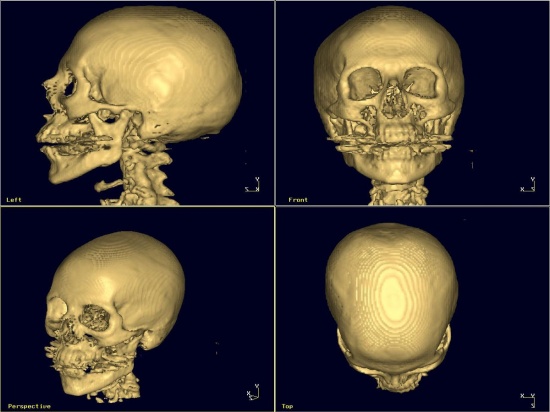 томография лицевой части черепа