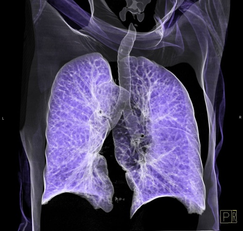 снимок легких на томографе