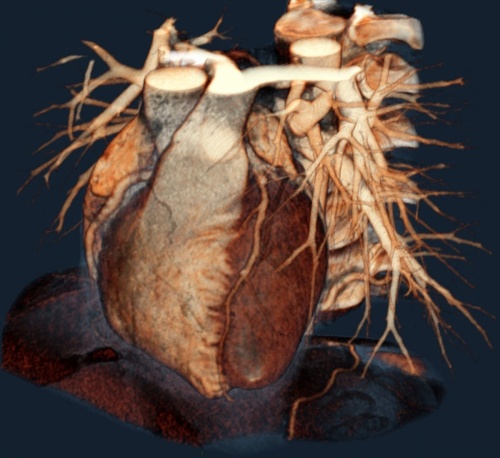 объемный снимок сердца на томографе