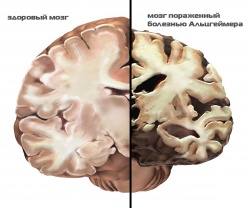 сравнение здорового и пораженного болезнью мозга
