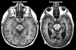 снимок мозга до и после Альцгеймера