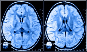 отображение мозга при томографии