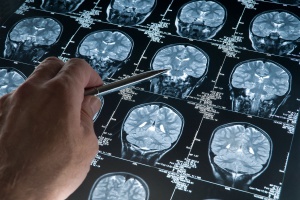 мозг на снимке при диагностике МРТ